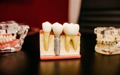 The Cosmetic Benefits of Dental Implants